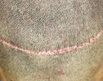 後頭部に残ってしまった植毛の傷跡例　横一直線にメスの跡が残っている