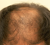 前頭部から後頭部にかけて地肌が露出している　側頭部と後頭部の髪の毛量は多い